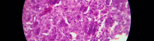 Bacteria in Tumors Research