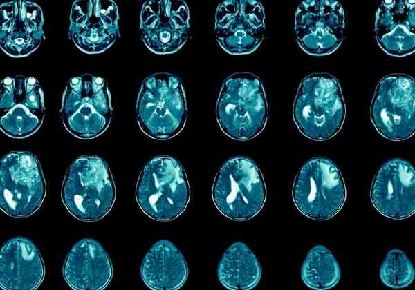 Downstream Target RSPO3 in Treatment Resistant GBM