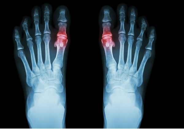 Balancing Anti-Inflammatory Efficacy and Toxicity in Rheumatoid Arthritis